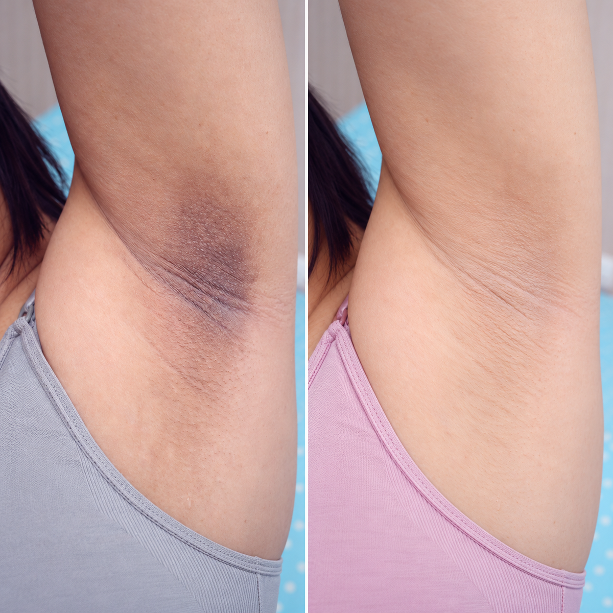 Pads Aclarantes para Manchas Oscuras Clenora